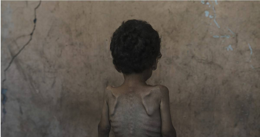 飢餓蔓延，加薩地區當地正面臨「大規模飢荒」。（圖／達志／美聯社，下同）