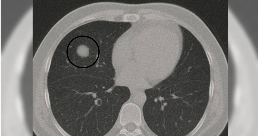 劉博仁醫師指出，部分肺結節可能只是暫時性的發炎反應，但也可能是早期癌症的警訊。（圖／翻攝自Facebook／劉博仁營養功能醫學專家）