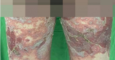 澎湖一名70歲老翁疑似打完疫苗全身出現性膿皰脫皮 。（圖／三總澎湖醫院提供／中國時報陳可文傳真）