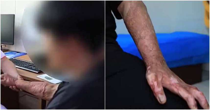 大陸吉林省一名18歲青少年小鄭在吸食打火機氣體「丁烷」時，不慎發生霸炸，導致他嚴重燒燙傷，儘管送醫後幸運救回一命，但小鄭的手指卻再也無法伸直。（圖／翻攝自CCTV）