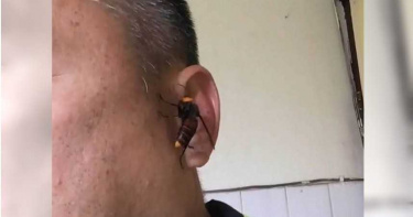 虎頭蜂飛進耳朵!5分鐘後一看傻眼 整塊肉沒了