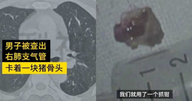 50歲男久咳不癒 醫照X光大驚:何時吞下這東西?