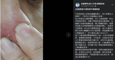 鼻頭白色條狀物擠出不少人覺得十分療癒，也擔心放著不管會變成痘痘，皮膚科醫生解釋其實放著不管也不要緊（圖／擷取自皮膚專科x詩人作家x狸貓爸爸臉書）