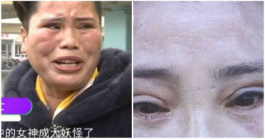 「萬人迷熟女」雙眼皮手術!「肉被割走」勾人眼不見 女神痛哭:我現在像妖怪