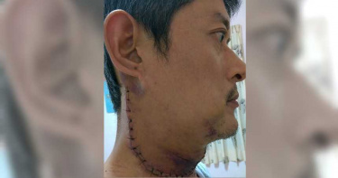 罹最短命癌!46歲男歷經37次化療 割大腿肉填補手術傷口