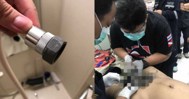 求刺激!男拿「螺旋配件DIY」 慘卡5天臭爛…GG整根切除