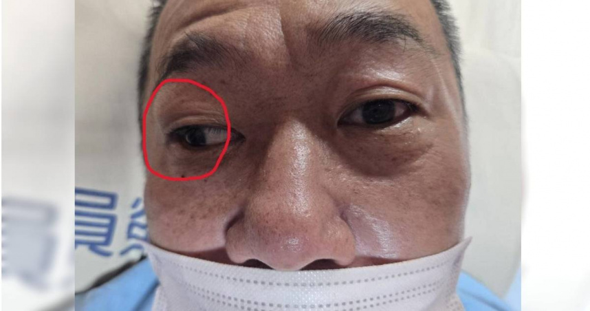 50多歲黃男子左眼可正常轉動，但右眼眼球(紅圈處)卻偏向一邊，經檢查確定是左側腦幹中風。（圖／員榮醫院提供）