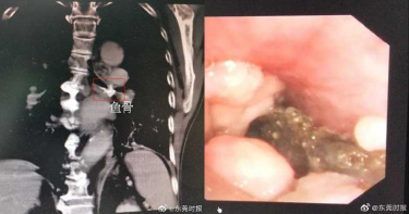 7旬老翁氣管卡魚骨近60年!醫檢查驚見「狀似1隻小雞腿」