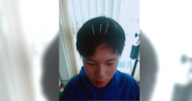 胃食道逆流誤當妥瑞氏症 中醫辨症七天見效