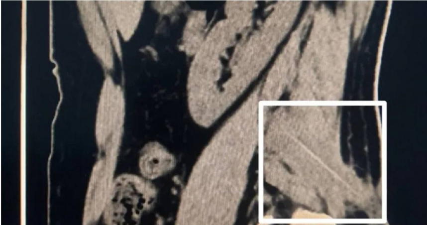 大陸湖南長沙一名48歲男子腰痛，看病半年都沒好轉，到醫院照X光才發現1根牙籤扎進他肉裡，他才想起自己某次喝醉叼著牙籤睡覺，才會渾然不自知。（圖／翻攝自微博）