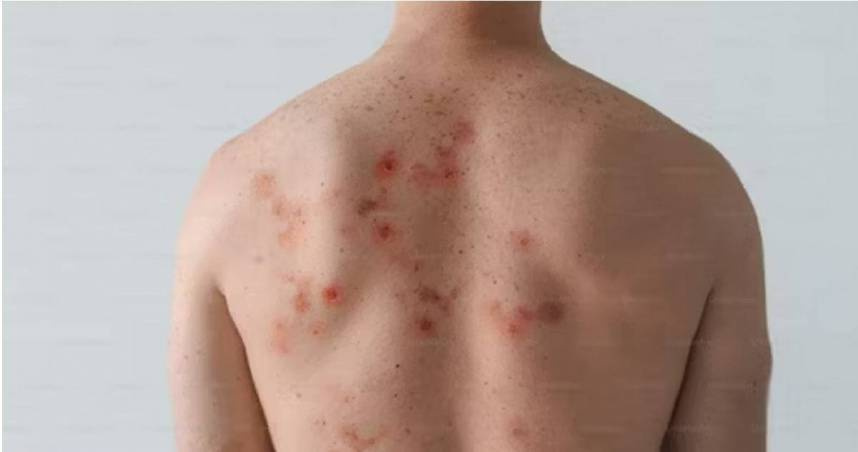 疾管署今天（22日）表示，我國今年截至4月21日，累計28例麻疹病例，為近6年同期最高。（示意圖／翻攝自unsplash）