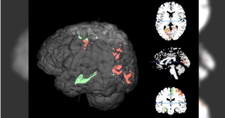 智慧腦影像平台BrainProbe能以個人化的方式定量不同大腦區域結構和功能退化狀況，作為後續診斷及精準腦刺激治療的客觀依據。（圖／陽明交大提供）