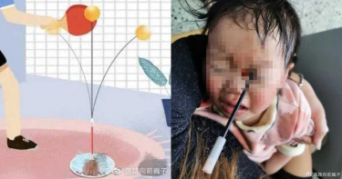 「彈力乒乓球」頻爆意外!軟軸直插3歲女童左眼…顱內積血損視力