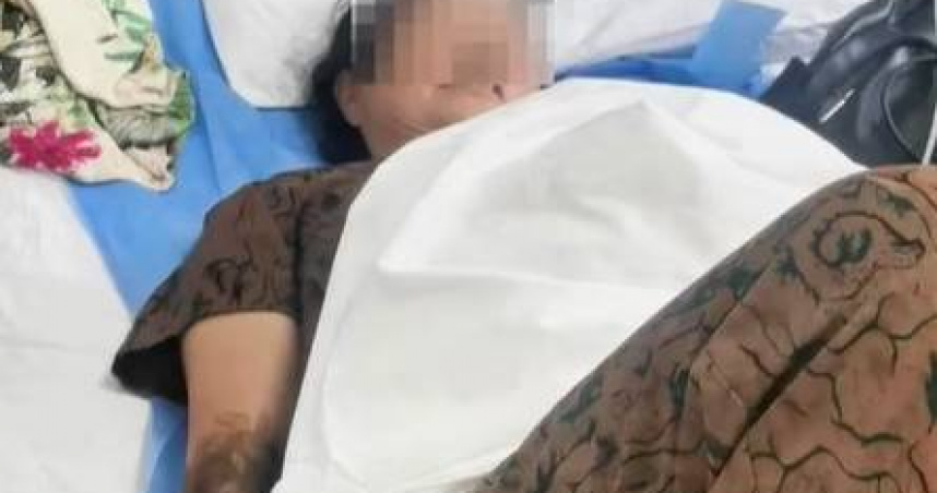 四川61歲龐女士被蛇咬傷。（圖／翻攝自微博）