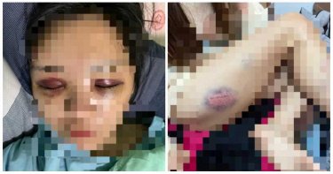影/22歲正妹遭痛毆!小腿被打斷「爬腳邊求救」 狠男家人冷回:太愛她才失控