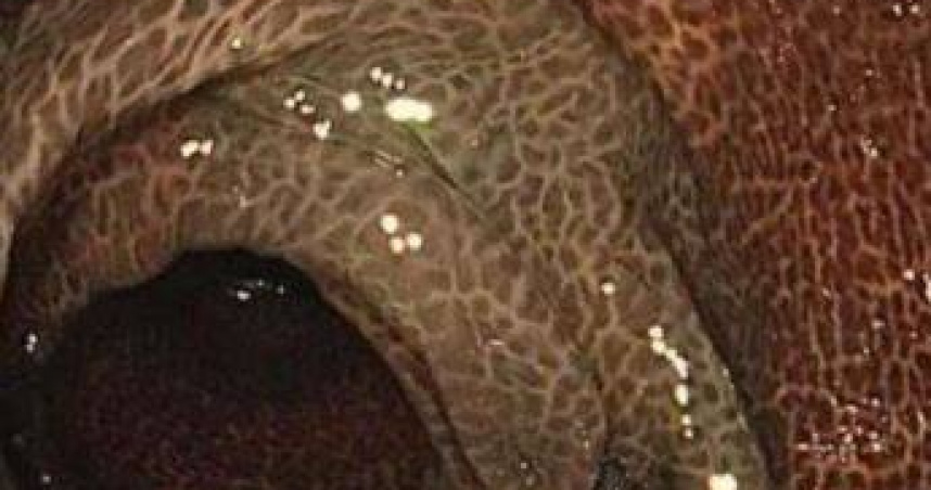 醫生在手術中發現，患者部分結腸已失去彈性，腸壁呈現異常黑色，甚至出現如豹紋般斑駁紋路。（圖／翻攝自微博）