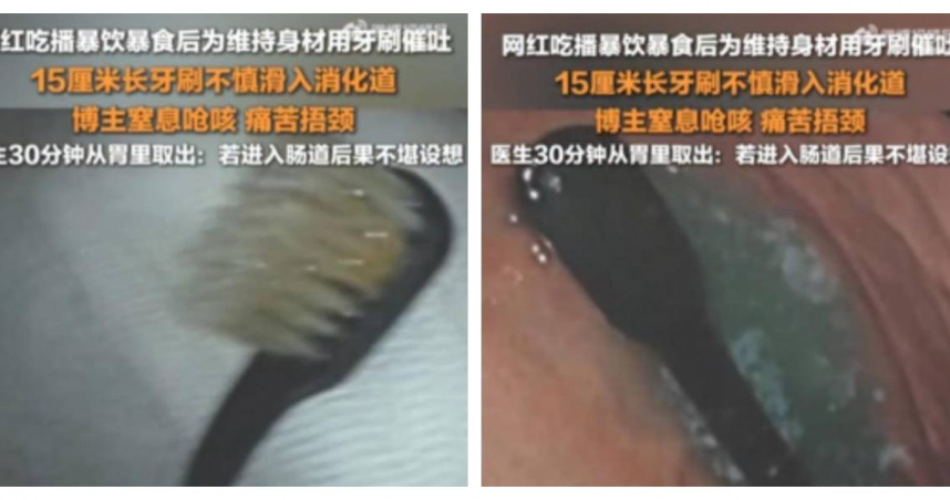 大陸某網紅用牙刷催吐，不慎吞下整支牙刷。（圖／翻攝自微博）
