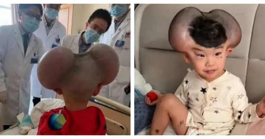 3歲男童「琪寶」因罕見的先天性巨痣，頭部兩側長出了像氣球般巨大的黑色胎記。（圖／翻攝自微博）