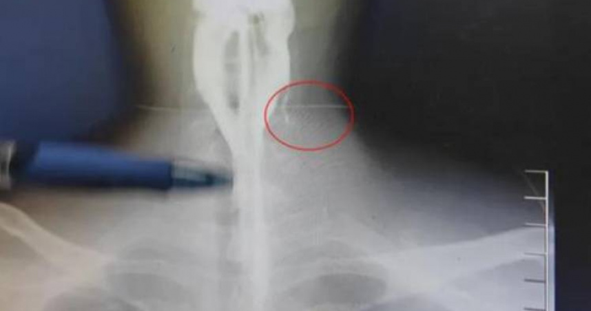 大陸工程師阿偉（化名）的脖子最近突然腫了一塊大包。（圖／翻攝自微博）