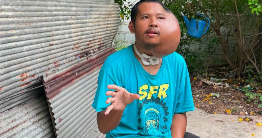 泰國一名31歲男子近日因左臉出現巨大腫塊引發關注，外界質疑照片疑似經過後製或AI生成。（圖／翻攝自臉書，Poramet Misomphop）