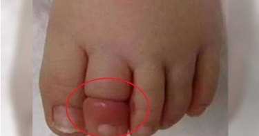 1歲女哭鬧不休…母驚見腳趾上「卡頭髮」 醫生:再晚恐將截肢