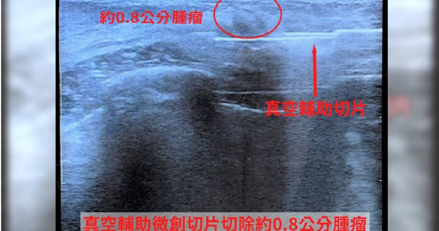 24歲年輕女性乳房疼痛，原來是腫瘤作祟。（圖／中國醫藥大學新竹附設醫院提供）