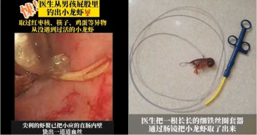 想學荒野求生王灌腸…男把小龍蝦塞肛門「變蝦乾」 糗靠大腸鏡「釣出來」