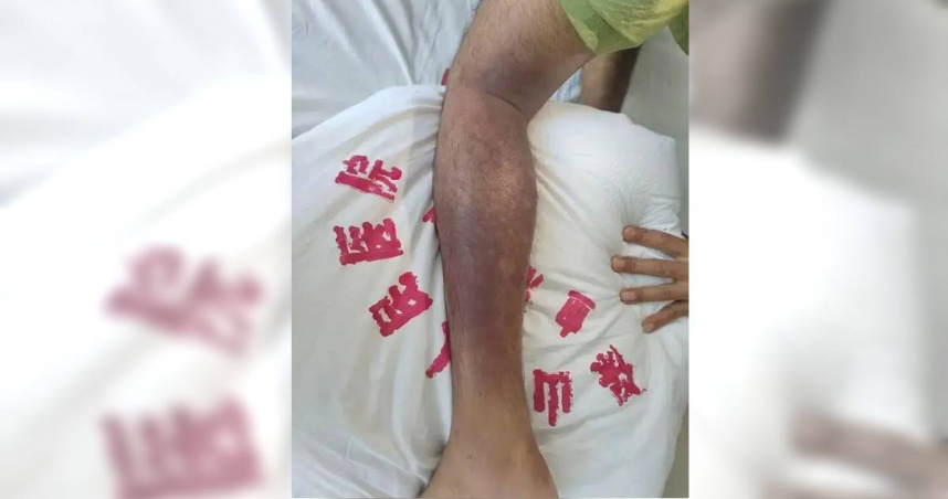 中國雲南省一名男子遭毒蛇狂咬休克昏迷，所幸經治療後已無大礙。（圖／翻攝微博）