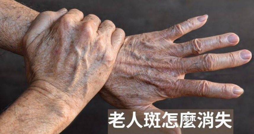 老人斑其實也象徵著身體一些狀況。(圖/翻攝自FB 思思醫師)