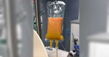孕婦連吃2天炸雞腹痛緊急送醫 血漿置換濾出數袋滿滿「油」