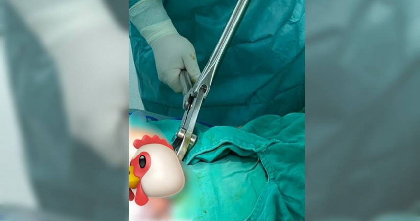 男子使用金屬陰莖環卻拿不下來，最後動用骨科專用鋼針剪解決，休養一周後才恢復正常。（圖／顧家醫療提供）