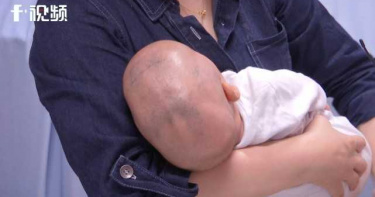 7月大嬰兒頭型似「外星人」 醫檢查:狹顱症需手術