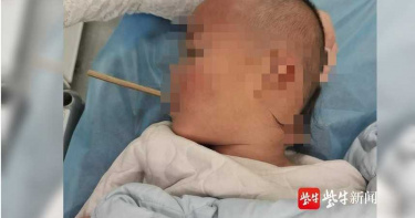 拿筷子插蘋果吃 2歲童摔倒「整根貫穿喉嚨」…後頸驚見凸出筷子頭
