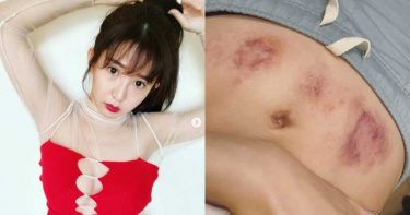 郭書瑤「肚皮滿布紫紅瘀青」 暖心安慰惹哭網:請好好照顧自己