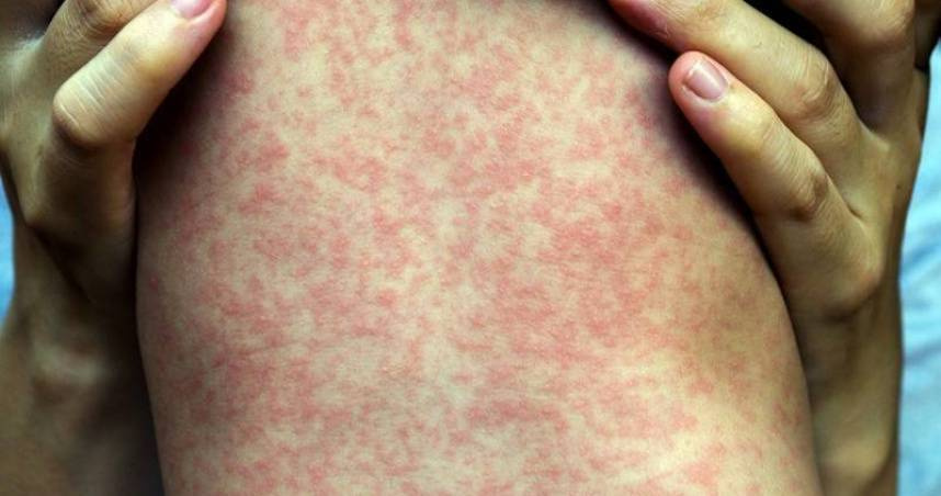 北部8個月大男嬰確診麻疹，為今年首例境外移入病例。（示意圖／翻攝自NHS）