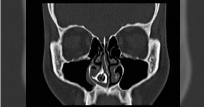 大陸杭州一名18歲女子以為自己鼻塞和流膿涕是因為慢性鼻竇炎，到大醫院檢查才發現鼻腔內竟有玩具串珠。（圖／翻攝自微博／環球網）