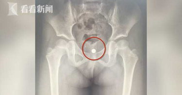 4歲女童玩具「電池少一個」 X光一照竟在陰道!取出已生鏽