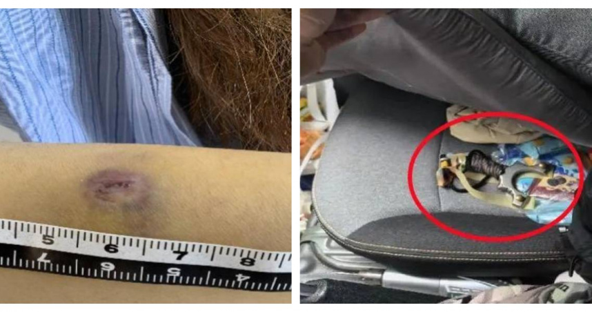 受害女子手臂遭鋼珠擊中，出現明顯圓形創傷。（圖／拱墅區檢察院提供）