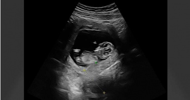 恭喜!楊祐寧先升格當人父 攜未婚妻曬寶寶超音波照