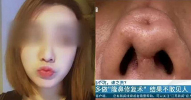 正妹花10萬隆鼻!歷經4回手術「凹大洞」…鼻頭歪扭變形毀容