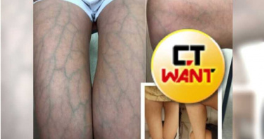 嫩妹腿浮藍色蜘蛛網!側邊爆出「肥碩蚯蚓」超驚悚 醫嚇:會致命