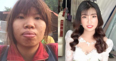 「厚唇痘痘妹」整型爽嫁豪門翻身!尪竟出軌 她PO白紗美照喜曝:下月再婚