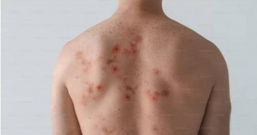 疾病管制署今（28日）公布國內新增1例境外移入麻疹確定病例，為中部30多歲男性，今年4月上旬曾至日本旅遊。（示意圖／翻攝自unsplash）