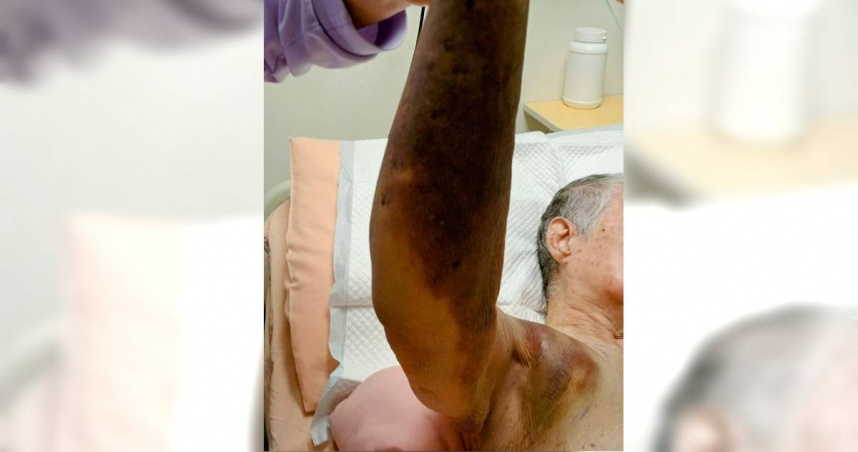 婦人身上出現多處瘀青，家屬質疑護理之家照護不當。（圖／民眾提供／中國時報記者葉靜美彰化傳真）