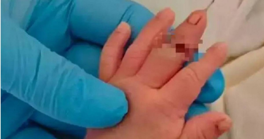 大陸一名新生兒的手指被助產士剪斷。（圖／翻攝自紅星新聞）