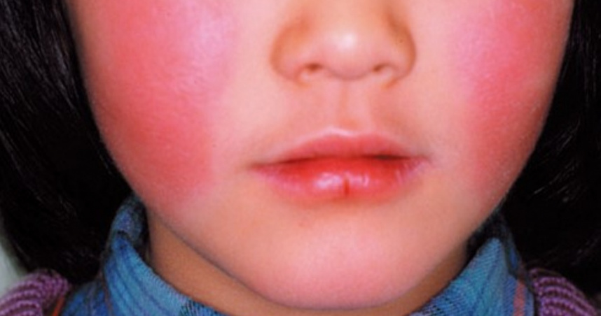 台中11歲女童猝死案，身上驗出B19病毒，該病毒會導致患者顏面出現出疹性紅斑。（示意圖，非當事女童／翻攝自日本厚生勞動省官網）