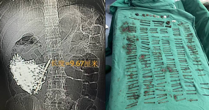 大陸雲南一名36歲男子連續9天腹痛又嘔吐，就醫檢查發現胃裡竟有180根鐵釘。（圖／翻攝自微博／極目新聞）