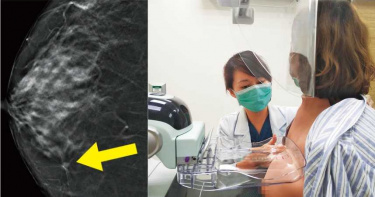 年輕更奪命3/好哀怨!定期篩檢卻沒檢查出腫瘤 關鍵出在乳房結構