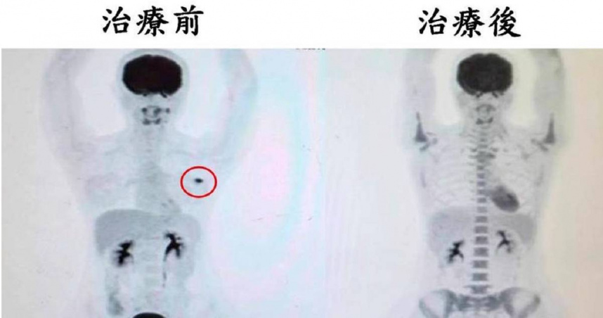 病人檢查發現有不規則腫瘤（紅圈處），經先期性化學治療及手術後，腫瘤細胞已完全消失。（圖／大千醫院提供）
