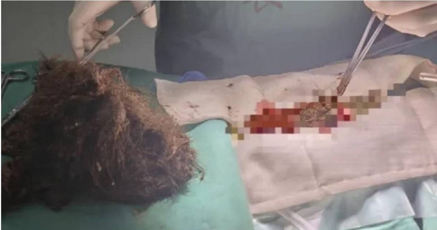 大陸浙江杭州一名25歲女子持續20年有吃頭髮的習慣，近期出現胃痛不適，就醫後才發現體內已有一顆1公斤重的頭髮結石。（圖／翻攝自微博／大象新聞）